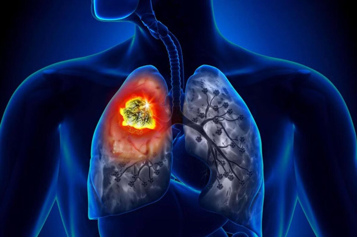 ميزان ابتلا به سرطان ریه در ایران ۲۰۲۵: دولت کشتن مردم خود است