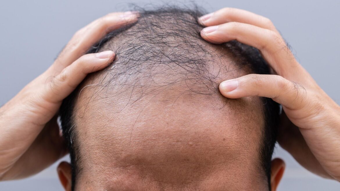 درمان طاسی در ۱۵ روز: واقعیت یا توهم؟