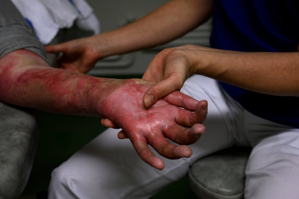 مصدومین سوختگی در ایران قربانیان بی‌توجهی رژیم